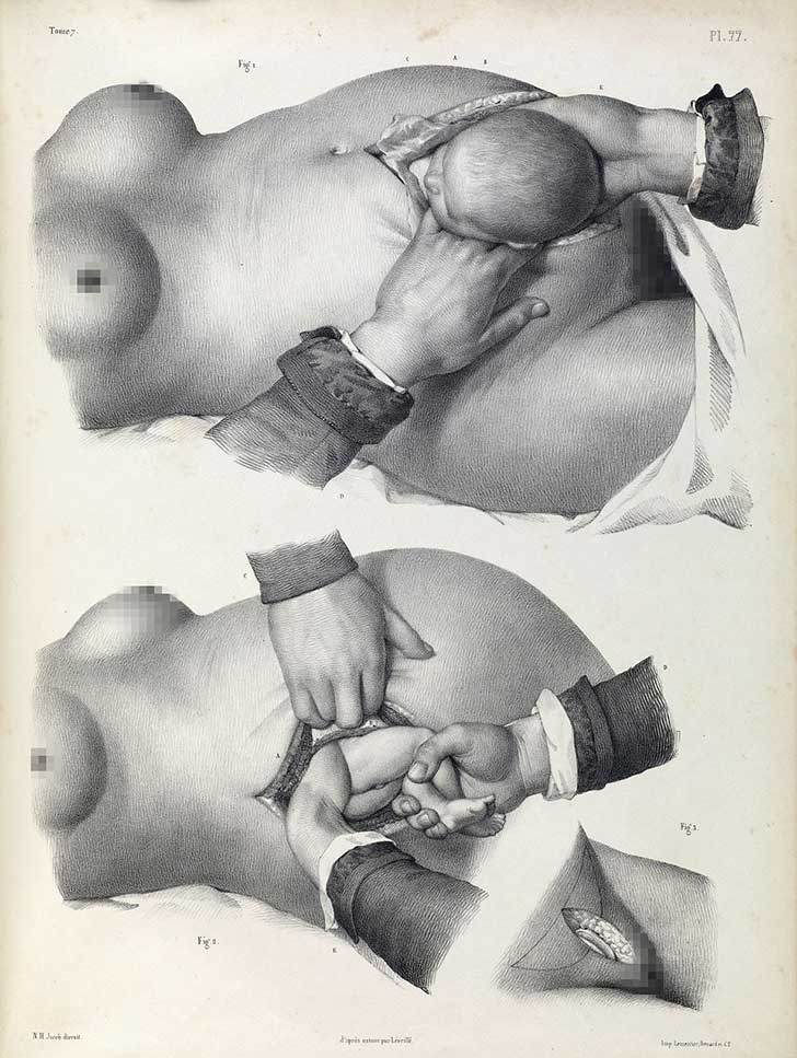 imágenes cirugía siglo 19
