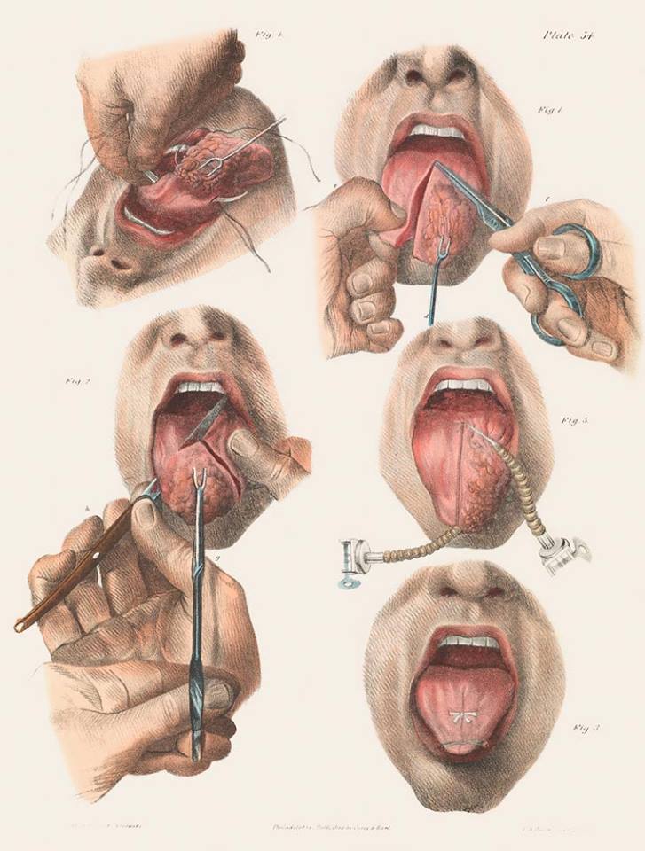 imágenes cirugía siglo 19