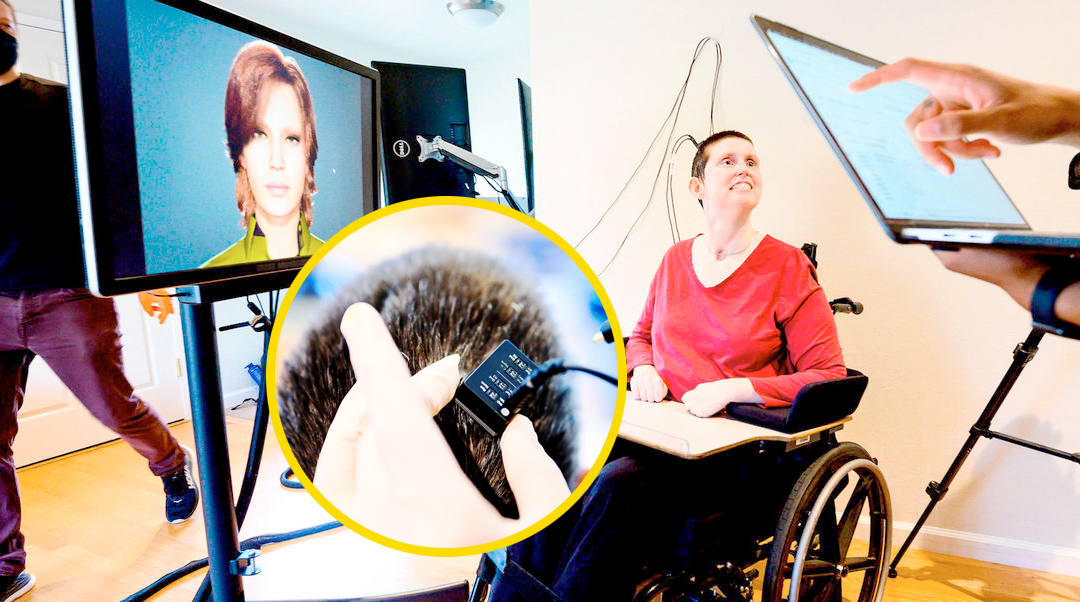 Mujer con parálisis vuelve a ‘hablar’ gracias a implante cerebral y avatar digital